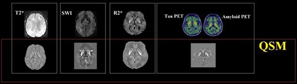 探索定量磁化率影像（QSM）在脑科学研究中的前沿应用